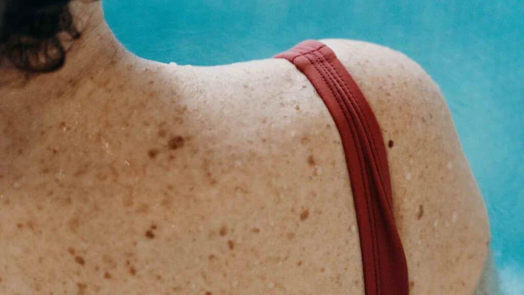 brązowe plamy na ciele