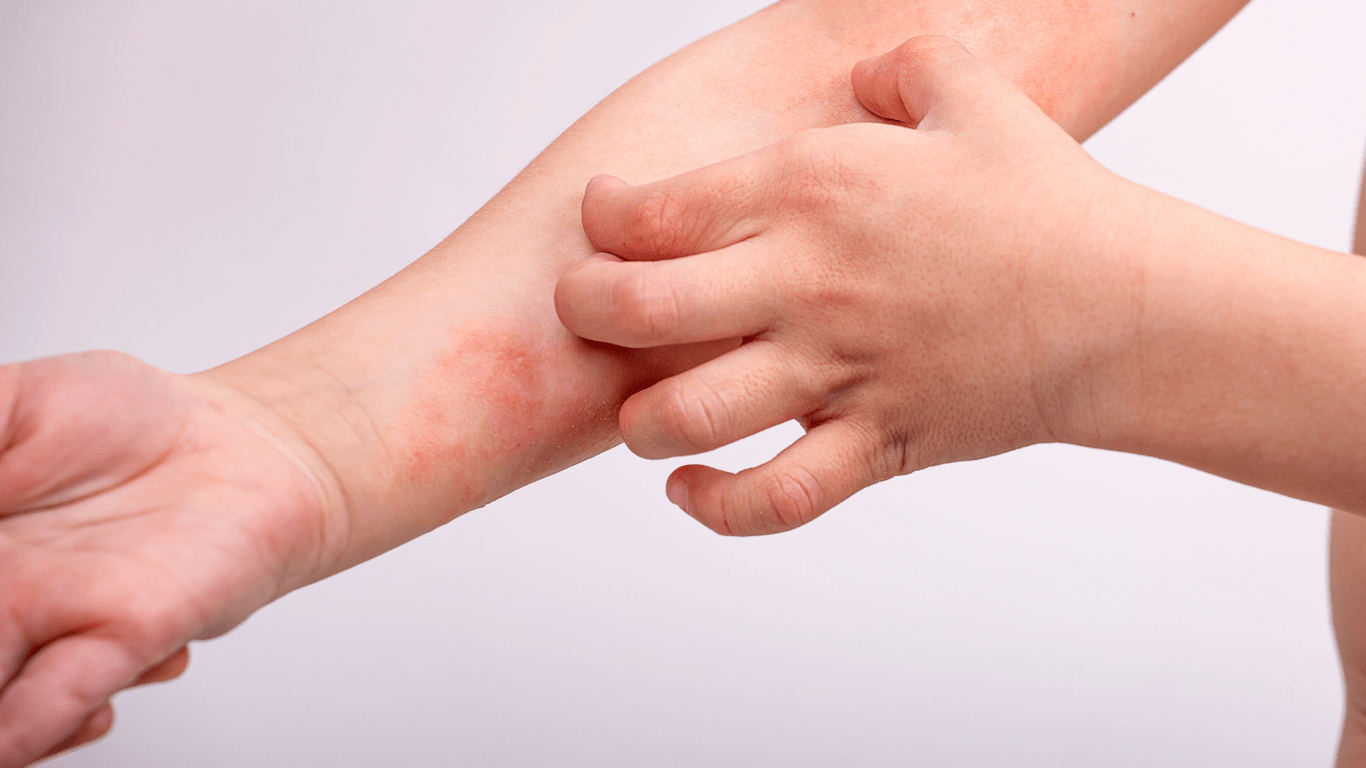 atopowe zapalenie skóry