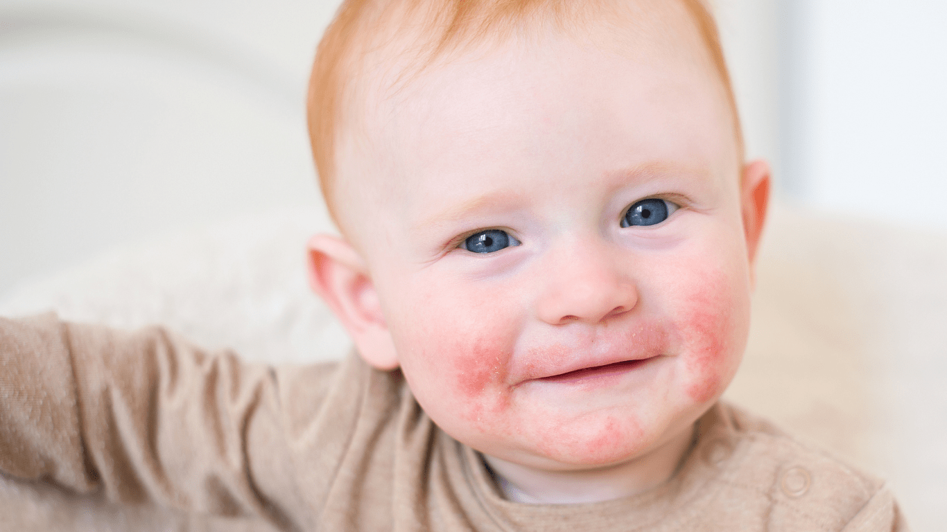atopowe zapalenie skóry u dzieci