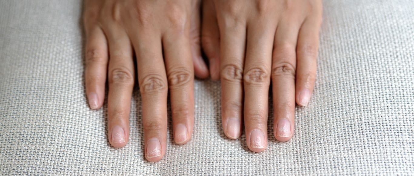 pielęgnacja paznokci w czasie leczenia onkologicznego