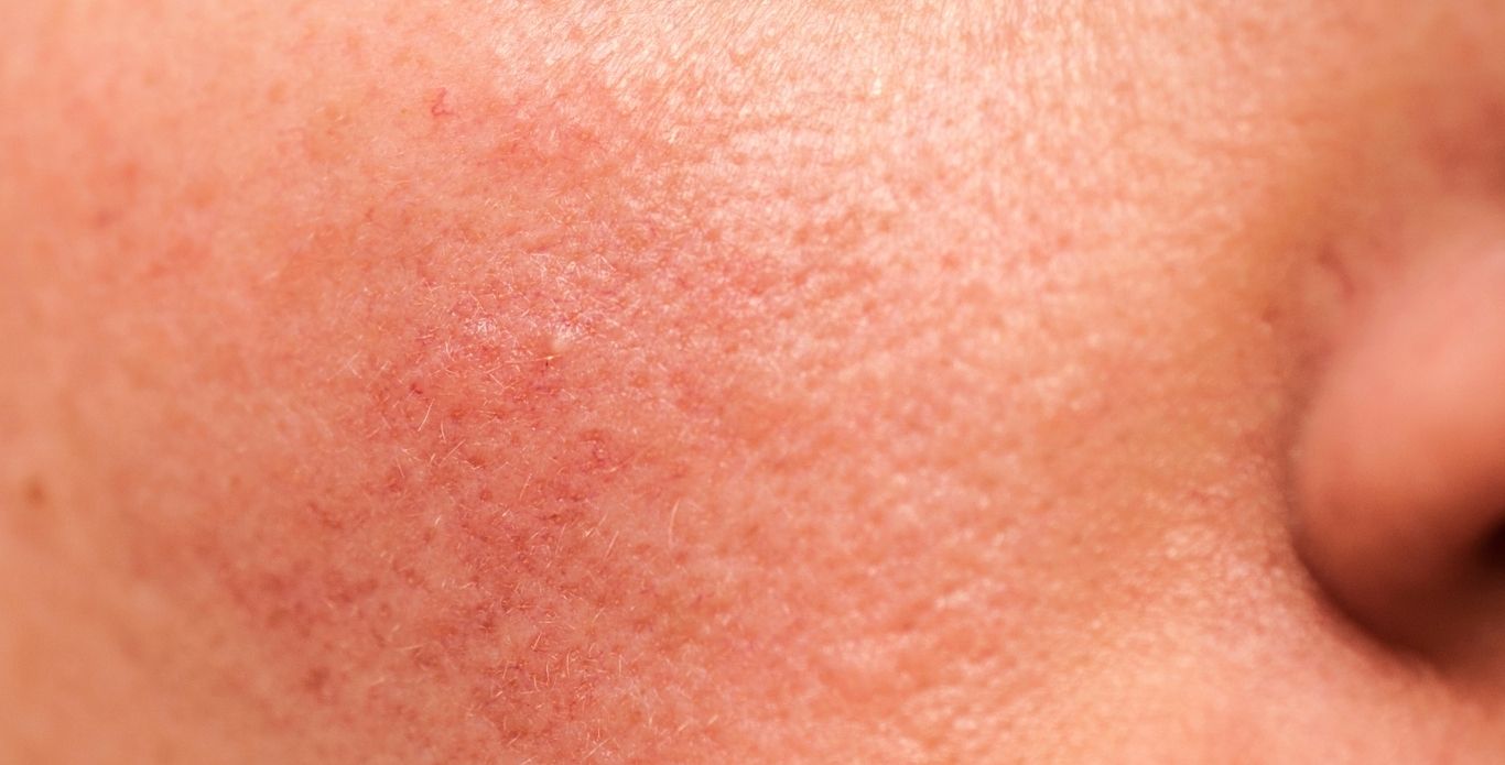 jak odbudować uszkodzoną barierę hydrolipidową, sucha skóra