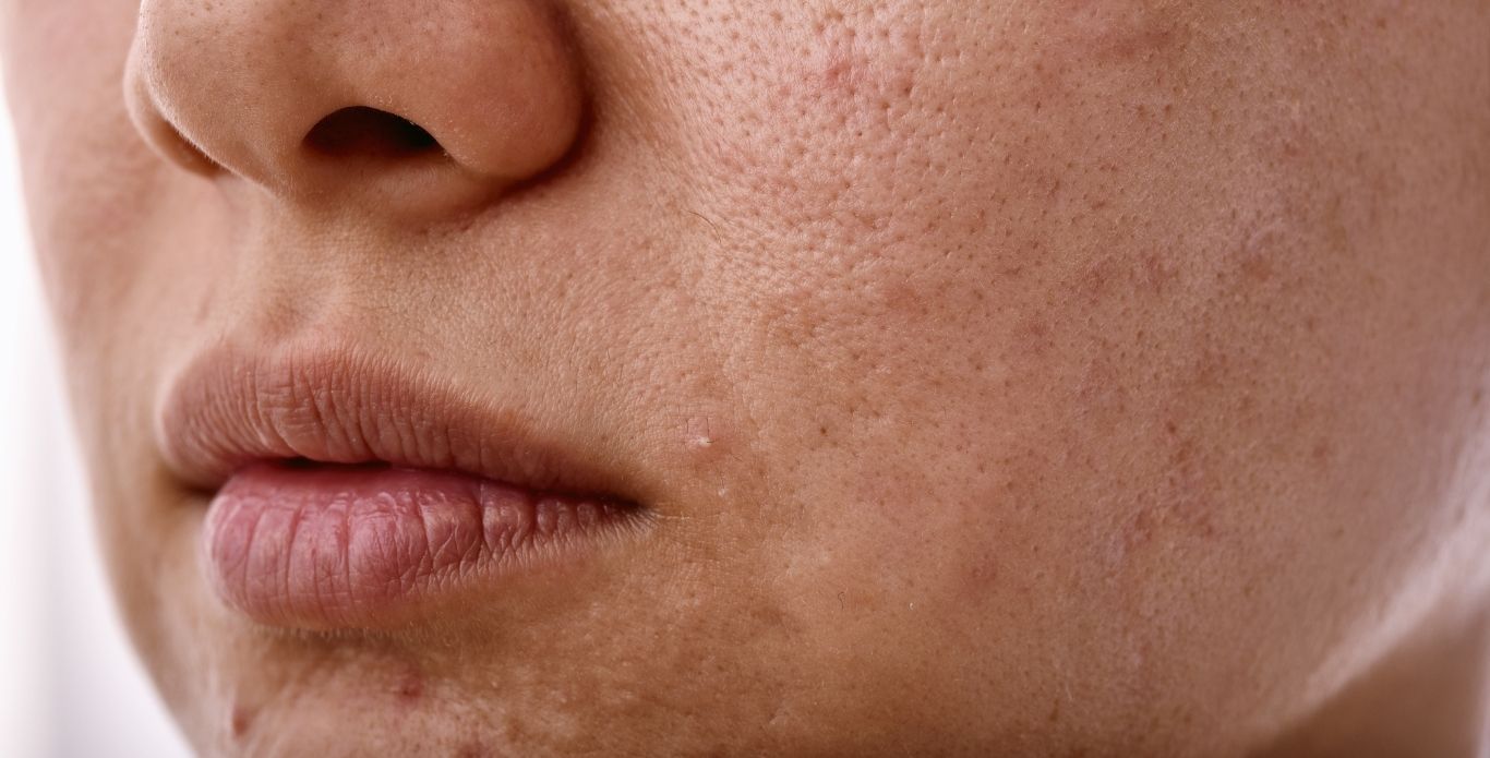 jak odbudować uszkodzoną barierę hydrolipidową, rozszerzone pory