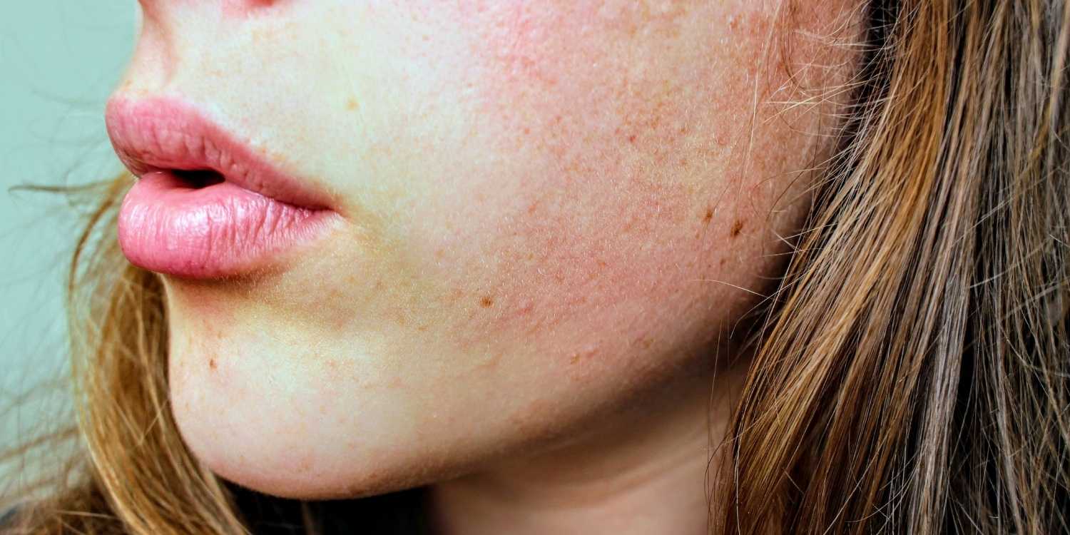 Sucha ściągnięta skóra twarzy po myciu